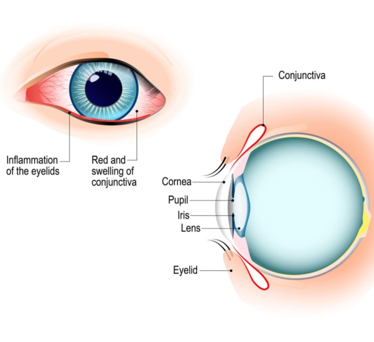 Παθήσεις Κερατοειδούς