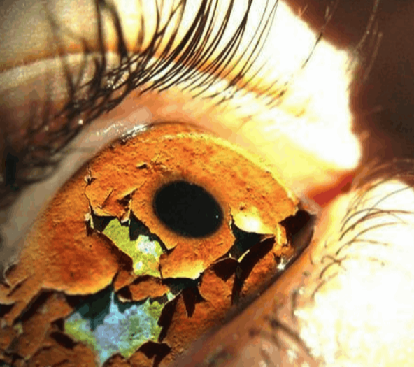 Θεραπεία Συμπτωμάτων Ξηροφθαλμίας