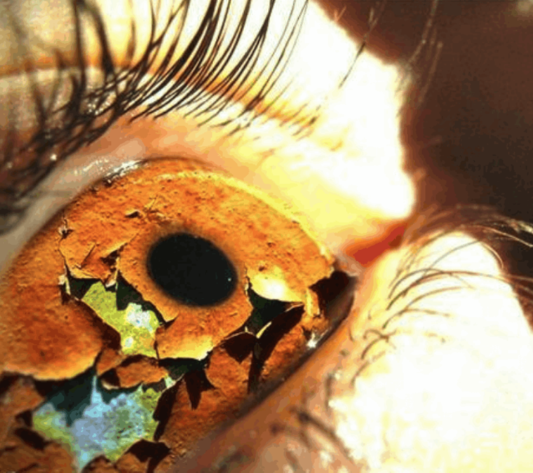 Θεραπεία Συμπτωμάτων Ξηροφθαλμίας