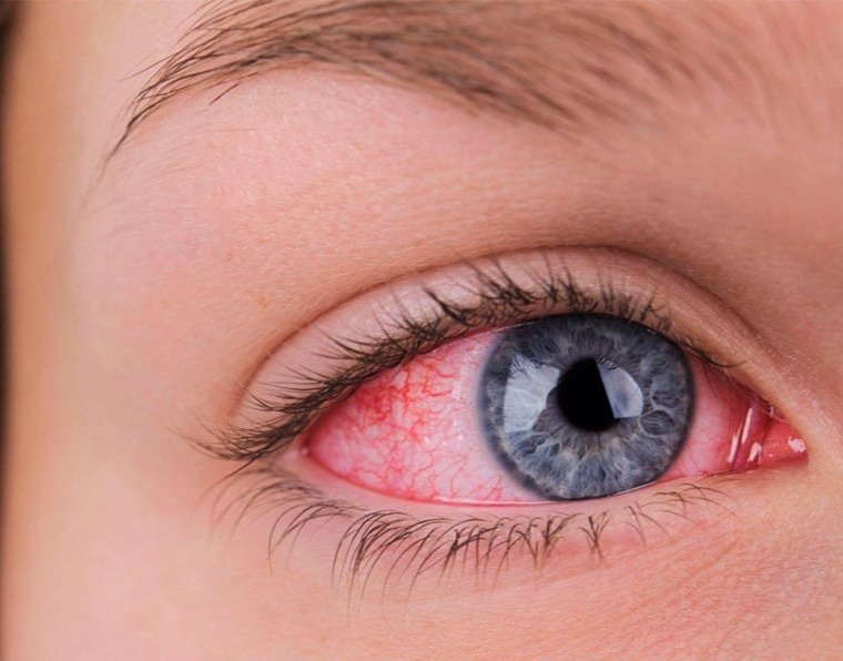 Παθήσεις Επιπεφυκότα