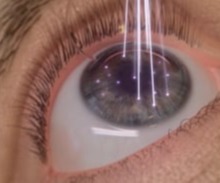 LASER διόρθωση Μυωπίας