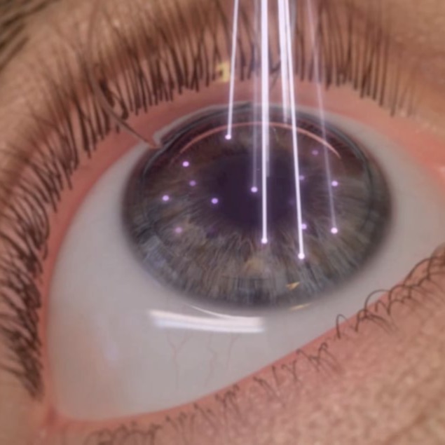 LASER διόρθωση Μυωπίας, Υπερμετρωπίας και Αστιγματισμού