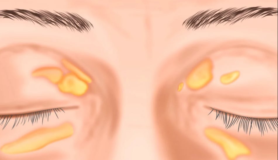 Ξανθέλασμα